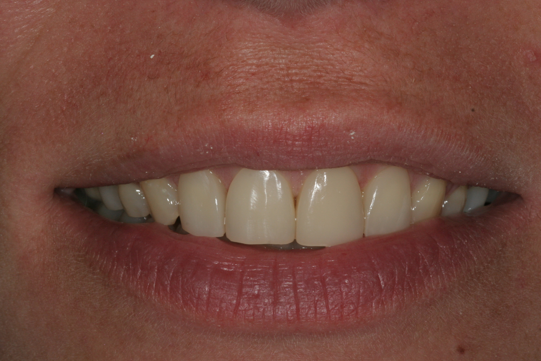 Compo Face Examples Compo Facings - Mondzorg Doorn - tandartspraktijk