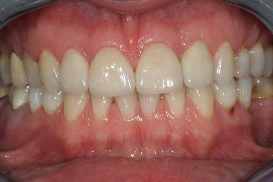 Facings